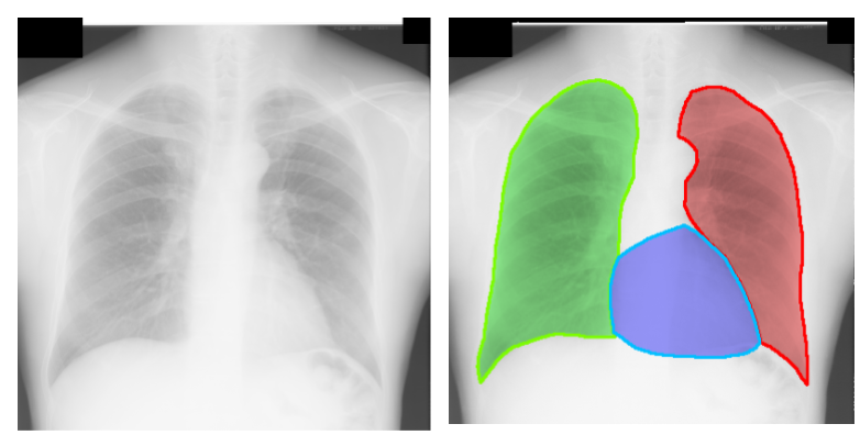 Segmented chest X-ray image [7]